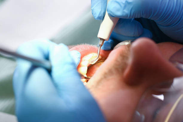 Best Emergency Wisdom Teeth Removal in Woodlake, VA