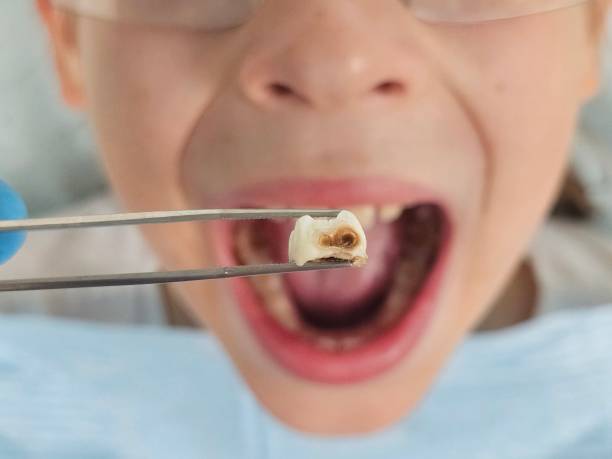 Best Emergency Treatment for Dental Infections or Abscesses in Woodlake, VA